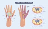 Carpal-Tunnel-Graphic_Advanced-Ortho-and-Spine-1536x920.png